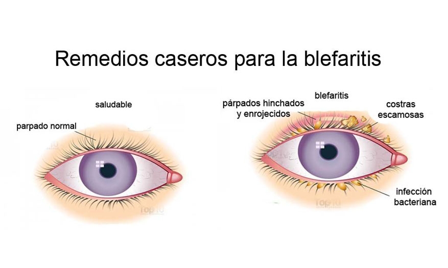 Blefaritis